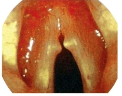 Forme de laringe asemănătoare tumorilor - noduli de cântărire ale laringelui, tratament la Moscova
