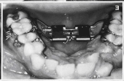 Microimplante ortodontice