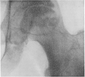 Tratamentul osteomului femural al tumorii benigne, onkostatus