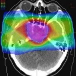 Tratamentul osteomului femural al tumorii benigne, onkostatus