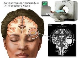 Edemul creierului după un accident vascular cerebral care sunt predicțiile pentru recuperare