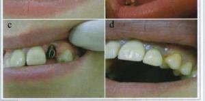 Késleltetett implantáció, orvosi közlemény