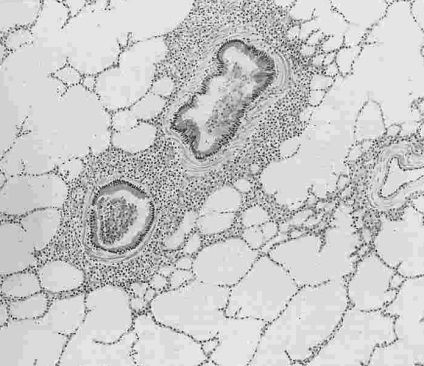 Anatomia patologică a organelor respiratorii ale organelor respiratorii cu caracter inflamator