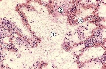 Anatomia patologică a organelor respiratorii ale organelor respiratorii cu caracter inflamator