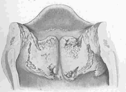 Anatomia patologică a organelor respiratorii ale organelor respiratorii cu caracter inflamator