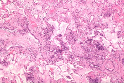 Anatomia patologică a organelor respiratorii ale organelor respiratorii cu caracter inflamator