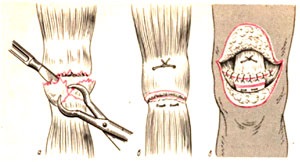 Fractura de patella