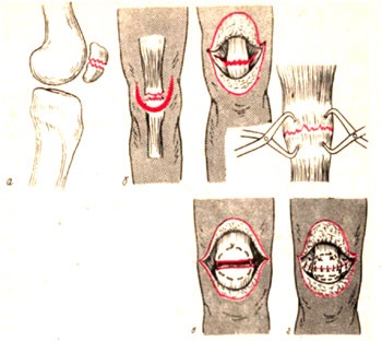 Fractura de patella