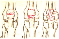 Fractura de patella