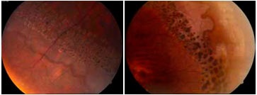 Perifériás vitreochorionetinalis dystrophies és terhesség