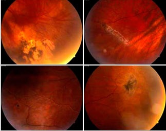 Perifériás vitreochorionetinalis dystrophies és terhesség