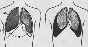 Pleurisia - tratament, simptome