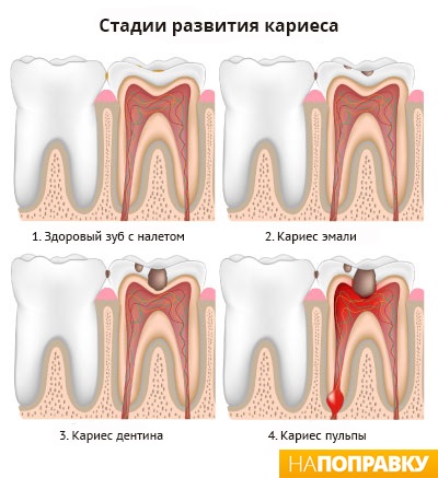 Umplerea dinților (canale dentare) informații generale și îngrijire - expediere