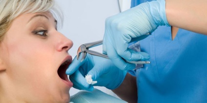 După îndepărtarea dintelui înțelepciunii, dinții vecini sunt răniți - cauzele complicațiilor și profilaxia după procedură