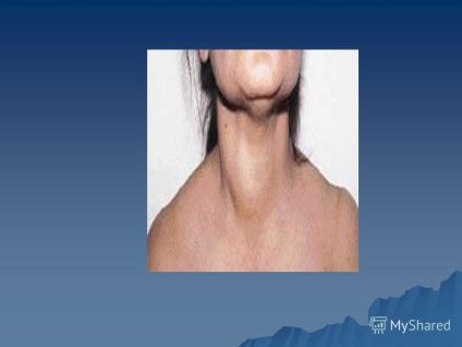 Prezentare pe tema hipertiroidismului - o boală în baza căreia este hipertiroidismul