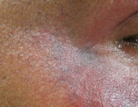 Cauzele și tratamentul hiperpigmentării feței