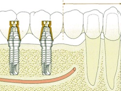 Протезиране разчитат на импланти