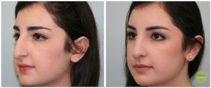 Rhinoplastia nasului în Makhachkala - fotografii înainte și după, video, recenzii, preț