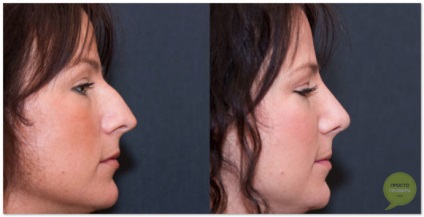Rhinoplastia nasului în Makhachkala - fotografii înainte și după, video, recenzii, preț