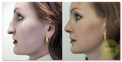 Rhinoplastia nasului în Makhachkala - fotografii înainte și după, video, recenzii, preț
