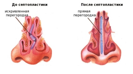 Septoplastie de corecție a curburii septului nazal