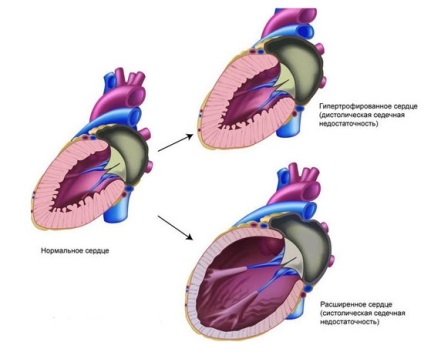 Simptome de insuficiență cardiacă, semne și tratament al medicamentelor populare - informații despre sănătate