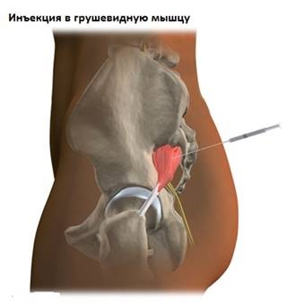 Sindromul muscular în formă de sare la domiciliu