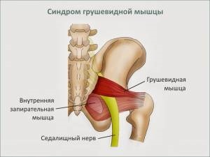 Sindromul muscular în formă de sare la domiciliu