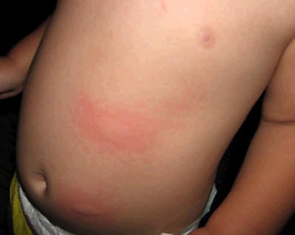 O erupție cutanată la nivelul abdomenului și spatelui unui copil fără o temperatură determină apariția de cosuri, tratament, fotografii și videoclipuri