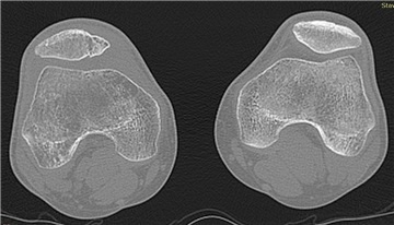 .ro • Vezi subiect - comminuted fracture of patella