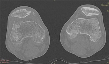 .ro • Vezi subiect - comminuted fracture of patella