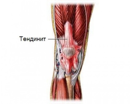 Tendinita simptomelor și tratamentului articulației genunchiului, fotografie