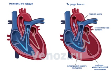 Phalo tetralogia este o boală cardiacă congenitală, tratamentul cancerului de col uterin la copii (prognostic)