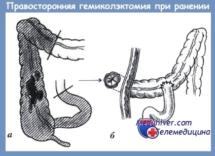 Tehnica chirurgicală pentru leziunea colonului