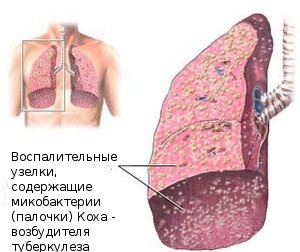 Туберкулоза причини, симптоми, диагностика, профилактика и лечение