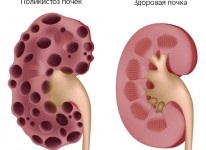 Uroseptice cu inflamație a medicamentelor pentru rinichi