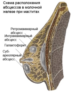 Tipuri de mastita - o descriere a diferitelor etape si sfaturi ale unui medic