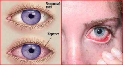 Inflamația ochiului la ce patologii apare și cum se tratează