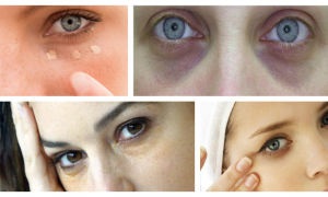 A szem gyulladása, mely patológiák fordulnak elő és hogyan kell kezelni