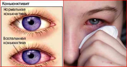 A szem gyulladása, mely patológiák fordulnak elő és hogyan kell kezelni