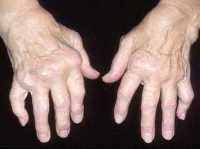 Az ujjak ízületein jelentkező fájdalom