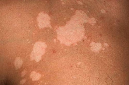 Mâncărimea pielii corpului - cauzează tratamentul mâncării pielii cu ajutorul unguentului