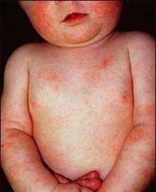Dermatita alergică la copii - ce trebuie să știți