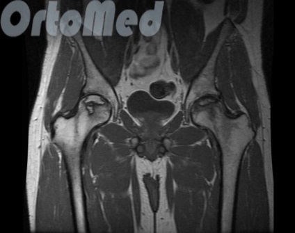 Anatomia articulației șoldului - articulația șoldului - ortopedie - articole