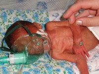 Apneea de prematuritate - cauze, simptome, diagnostic și tratament