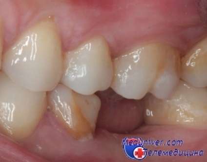 Cauze frecvente ale pierderii dentare