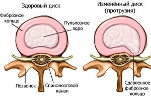 Care este proeminența discurilor coloanei vertebrale lombare