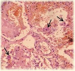 Infecția cu cytomegalovirus la copii, citomegalie - ce boală