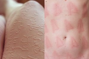 Dermatita urticară se referă la tipuri mecanice