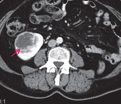Diagnosticul celulelor renale și al carcinomului tranzitoriu al celulelor renale - Kurzantsev